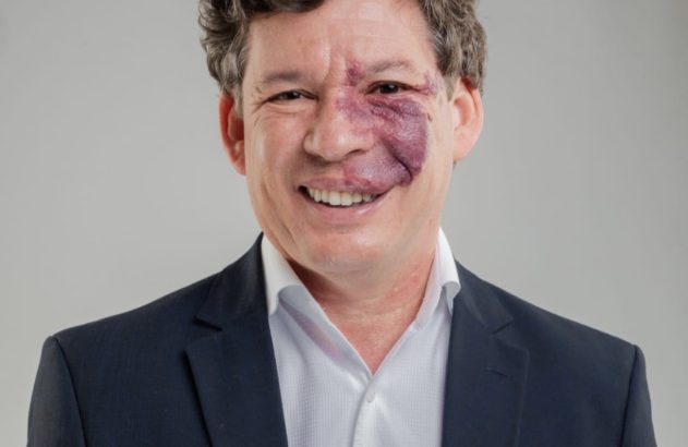 Homem sorrindo para a câmera, com uma grande mancha vascular de nascença em seu rosto, usando terno e camisa social.