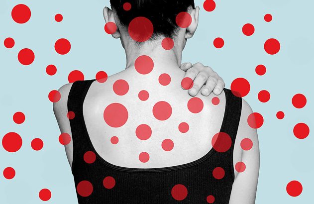 Mulher de costas com manchas vermelhas na pele e mão no ombro.